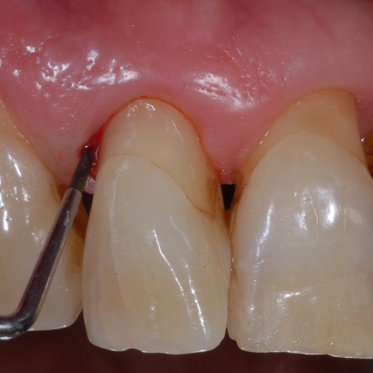 Sanguinamento gengivale