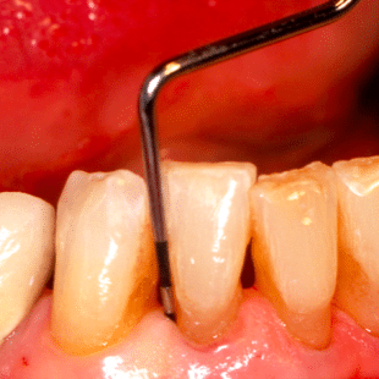 Misurazione tramite sonda della tasca parodontale