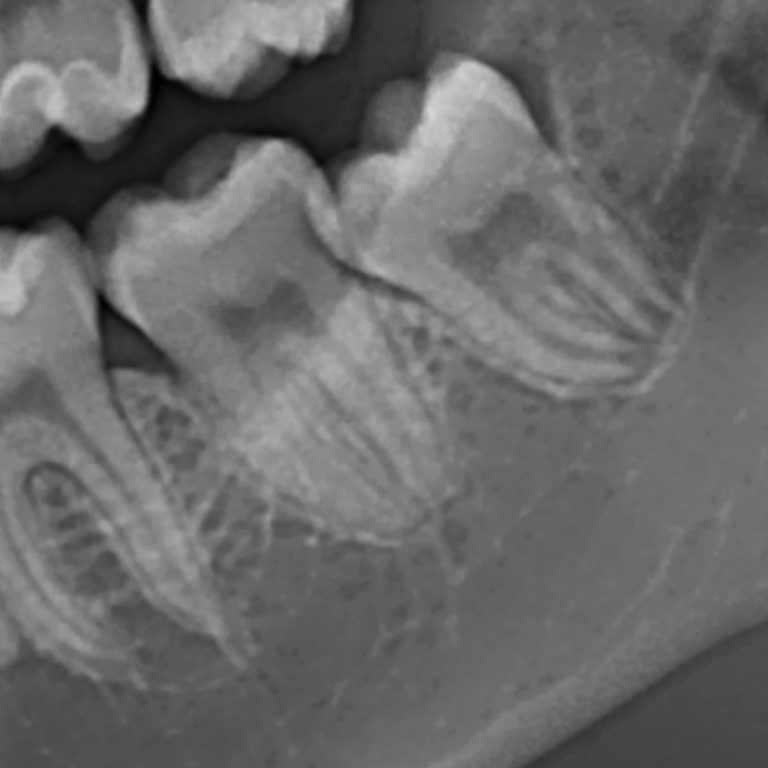 Terzo molare inferiore sinistro a contatto con il canale mandibolare