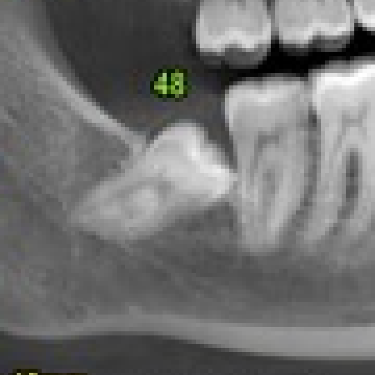 lesione nervo alveolare